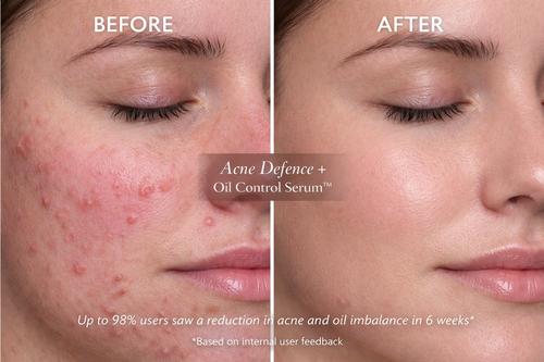 Acne Defence + Oil Control Serum | 2% Salicylic Acid + 5% Niacinamide | Oil-Free Korean Micro-Emulsion | Controls Acne, Oil & Pores | 30 ml